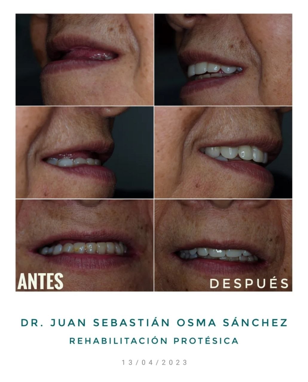 Trabajo de odontología DentArt Family en el norte de Bogotá